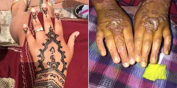 Avoid Black Henna: Aproko Doctor warns of severe skin damage and permanent scars